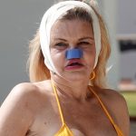 Danniella Westbrook Sunbathes with Bandages Around Her Head and Nose Out in Turkey (47 Photos)