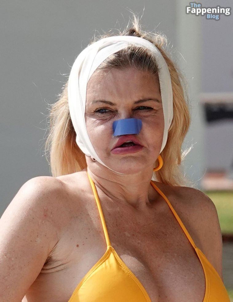 Danniella Westbrook Sunbathes with Bandages Around Her Head and Nose Out in Turkey (47 Photos)